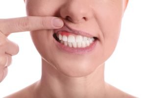 Gum Disease