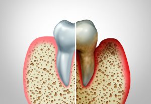 What Is Gum Disease